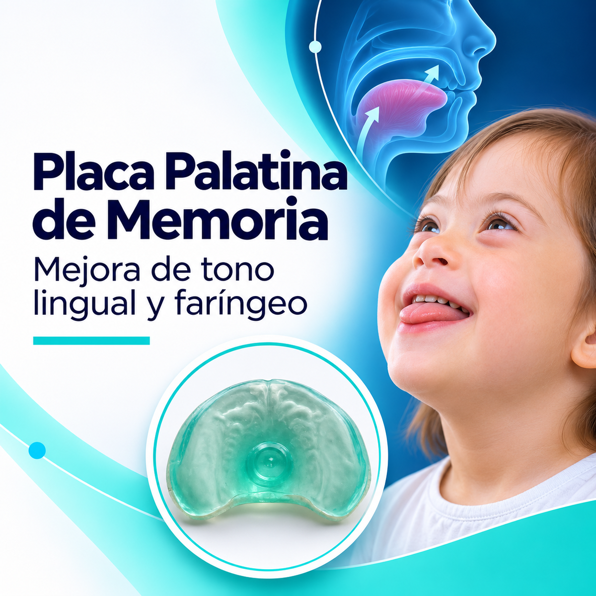 Placa palatina de memoria: indicación, diseño y seguimiento