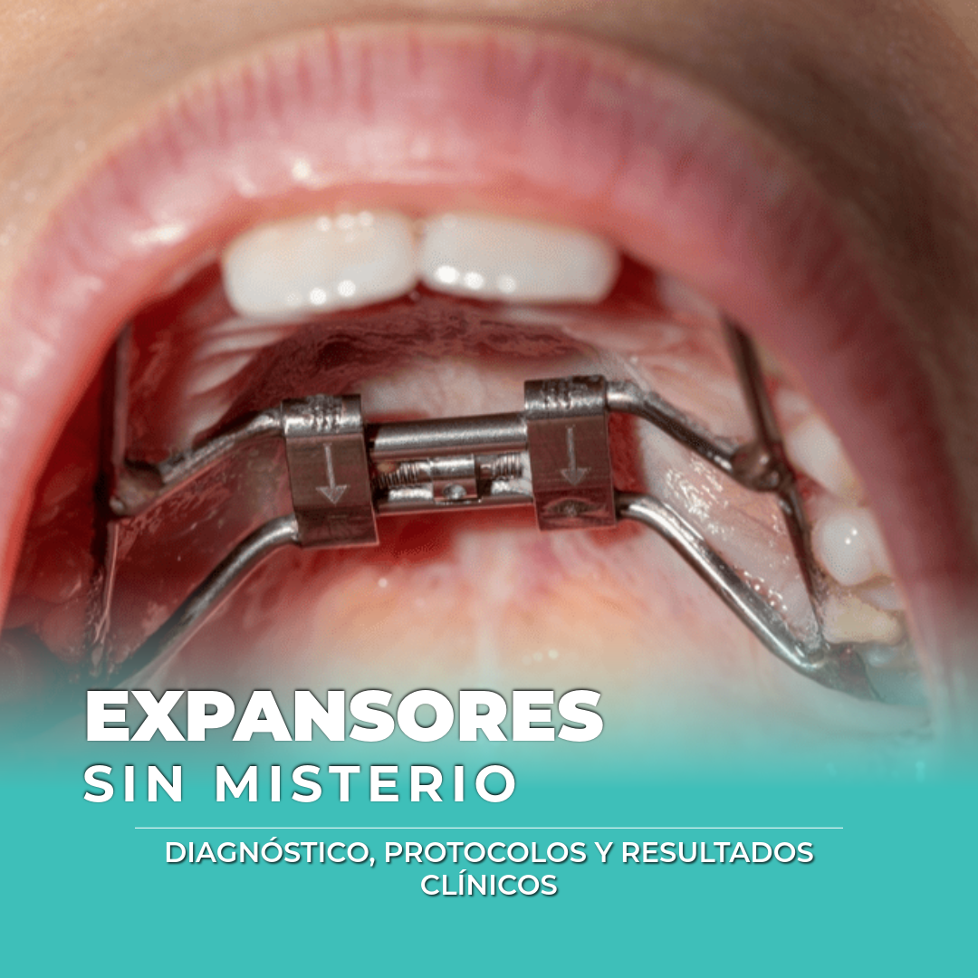 Expanders Unmystified Course - Functional Maxillary Expansion | Dr ...